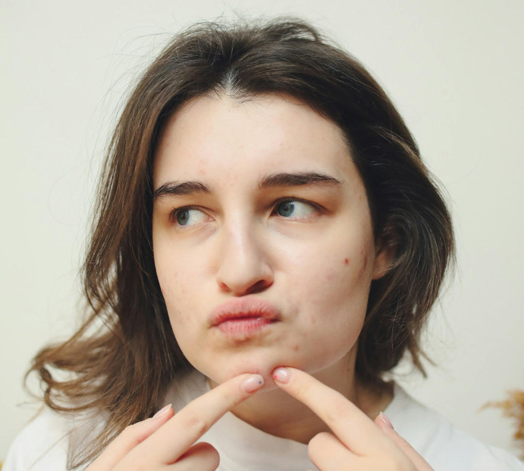 Best Korean Skincare for Acne-Prone Skin