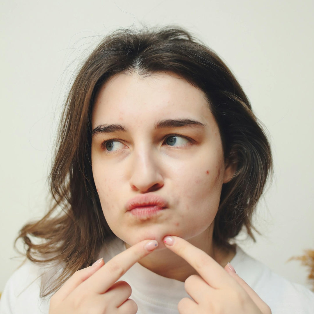 Best Korean Skincare for Acne-Prone Skin