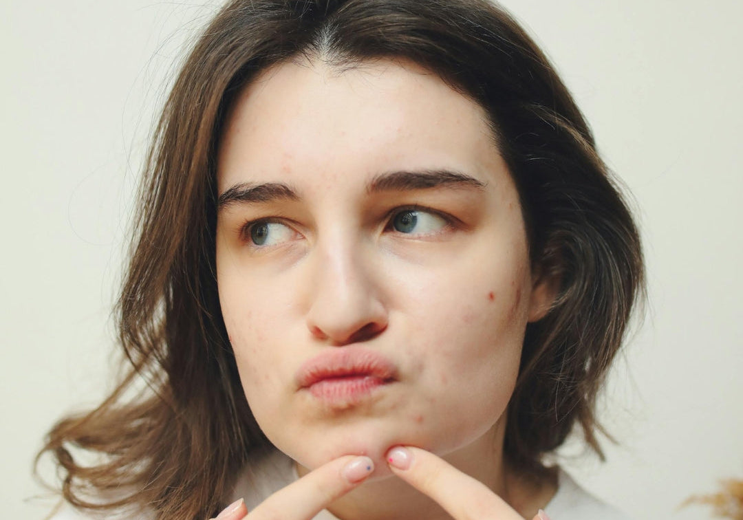 Best Acne Skincare: How to Clear Breakouts Without Over-Drying Your Skin