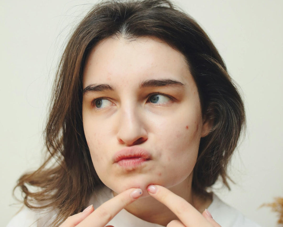 Best Acne Skincare: How to Clear Breakouts Without Over-Drying Your Skin