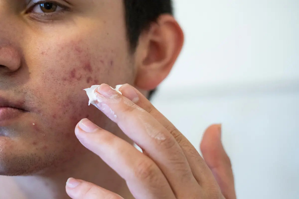 Best Moisturisers for Acne-Prone Skin
