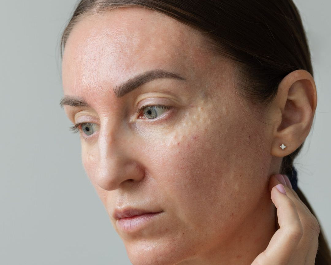 Best Cleanser for Clogged Pores: How to Choose the Right One for Clearer Skin