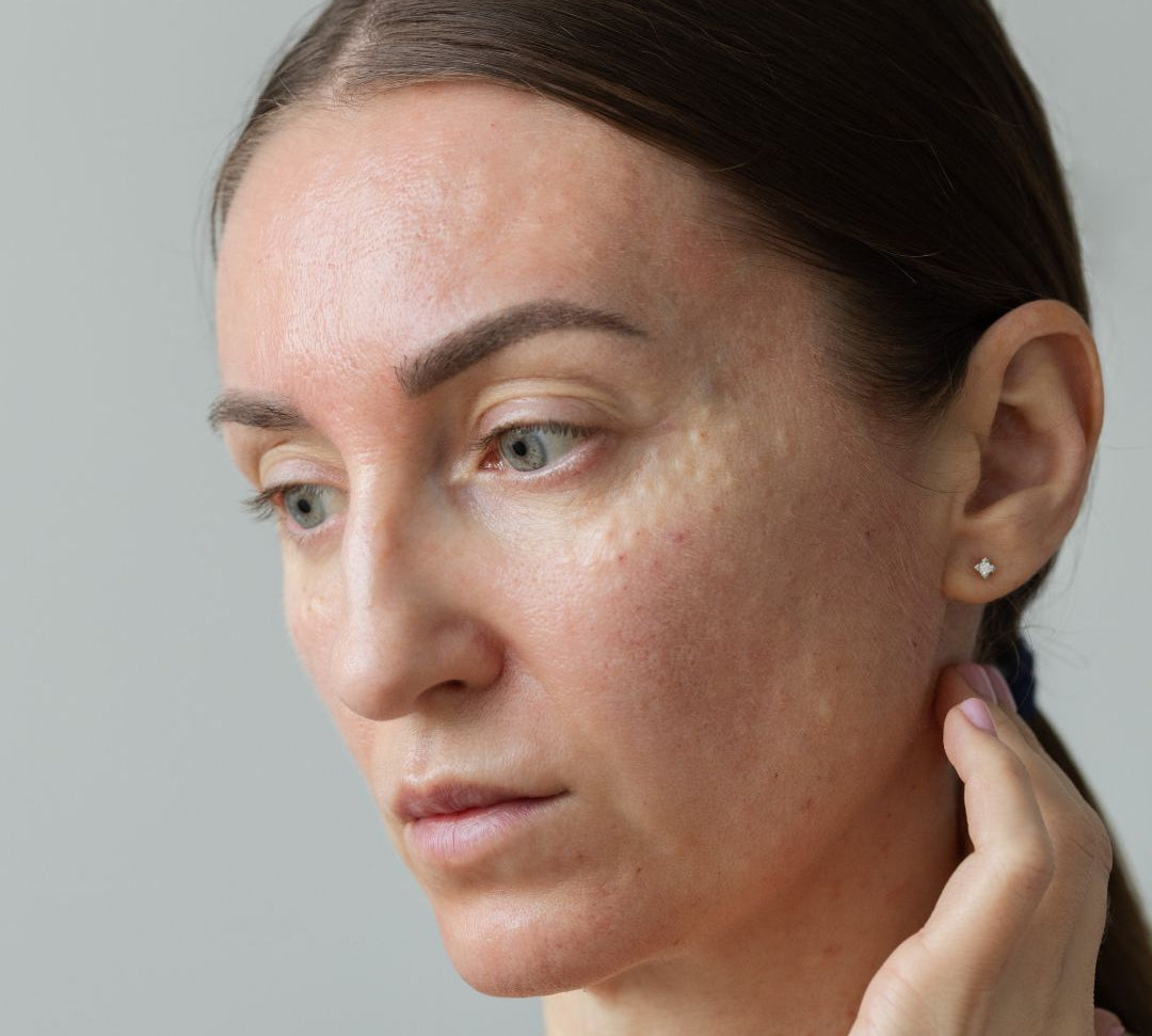 Best Cleanser for Clogged Pores: How to Choose the Right One for Clearer Skin