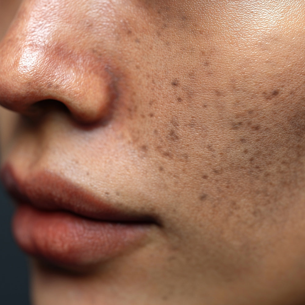Best Skincare for Pigmentation in Ireland: What Is Actually Worth Using?