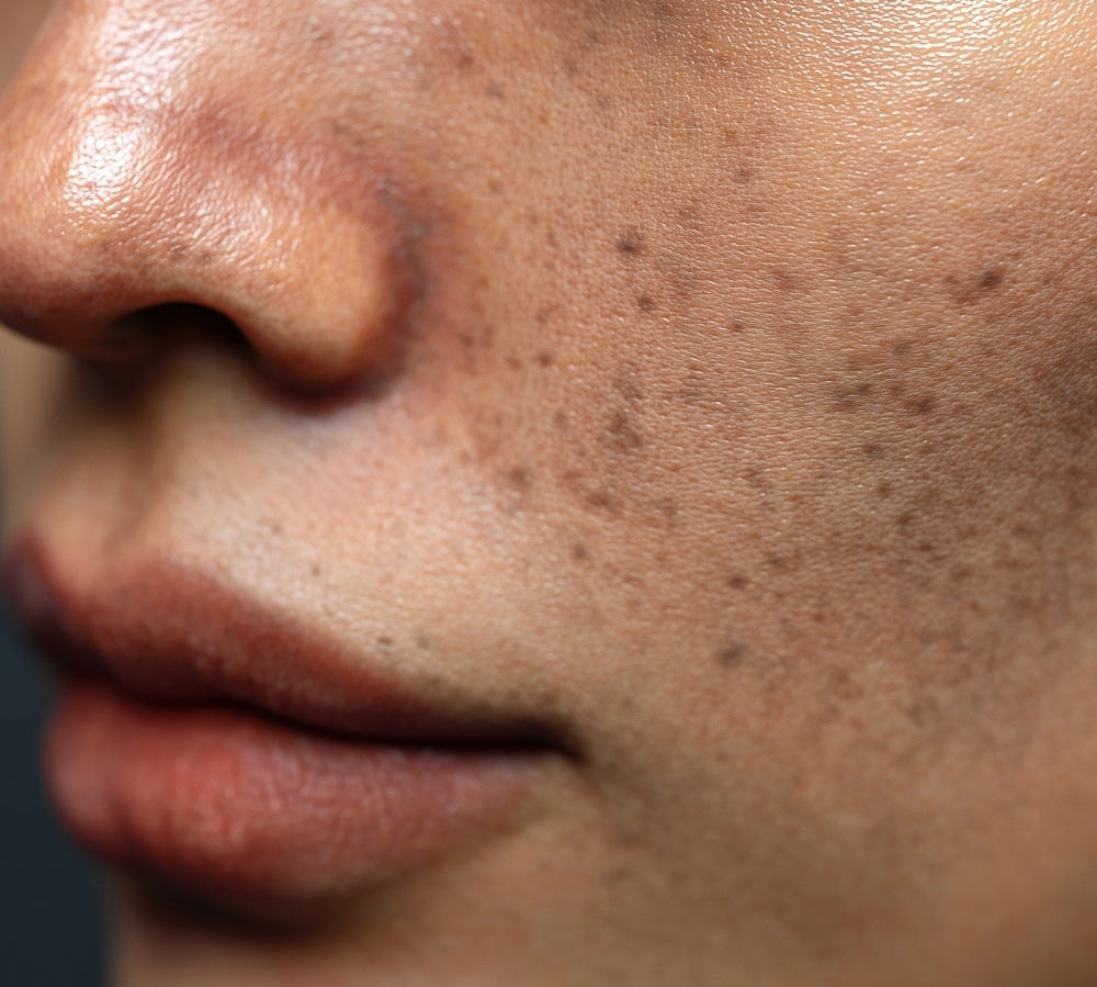 Best Skincare for Pigmentation in Ireland: What Is Actually Worth Using?