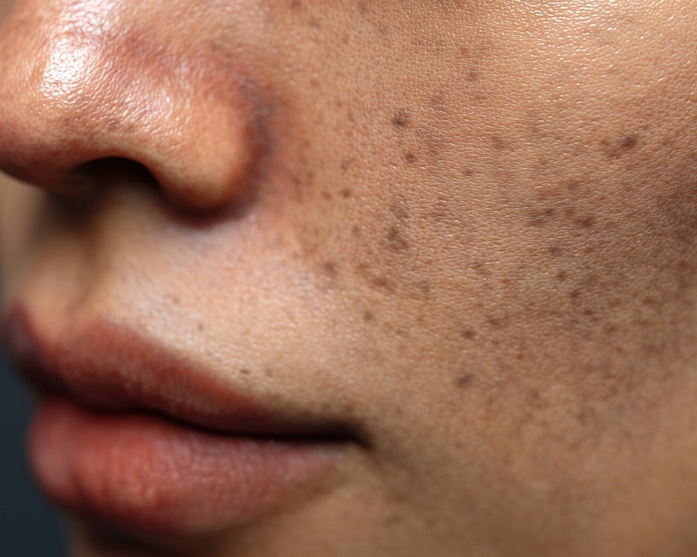 Best Skincare for Pigmentation in Ireland: What Is Actually Worth Using?