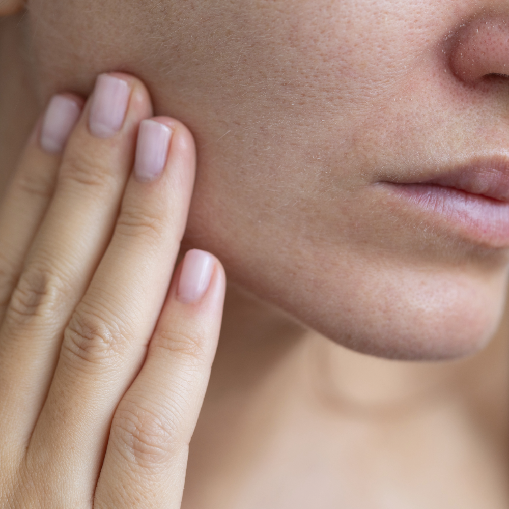 Winter Acne and Dry Skin: Why Your Skin Breaks Out When It's Already Dry