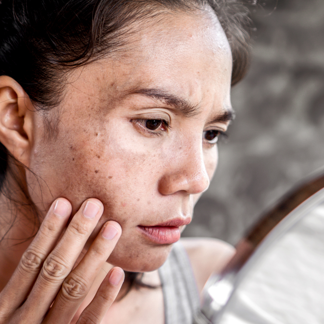 Best Skincare for Pigmentation and Dark Spots