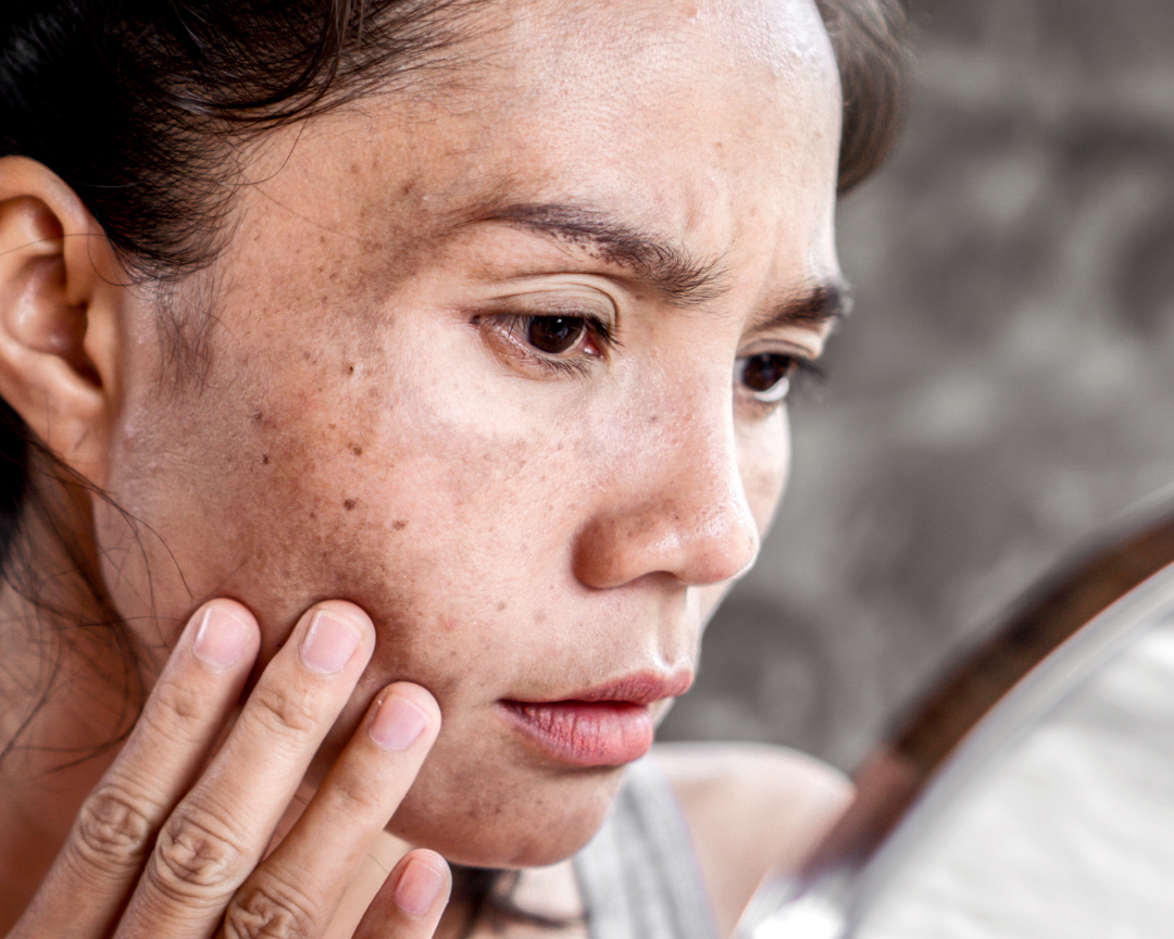 Best Skincare for Pigmentation and Dark Spots