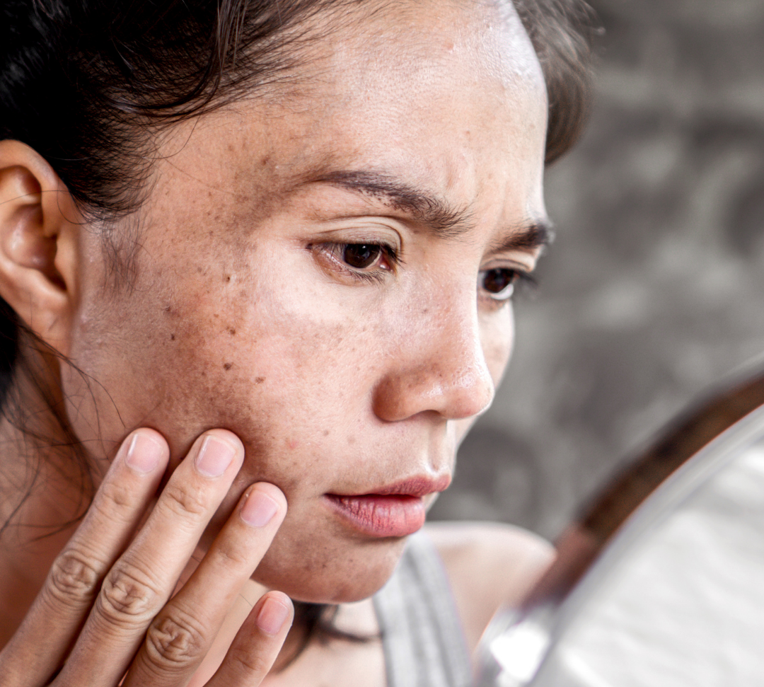Best Skincare for Pigmentation and Dark Spots