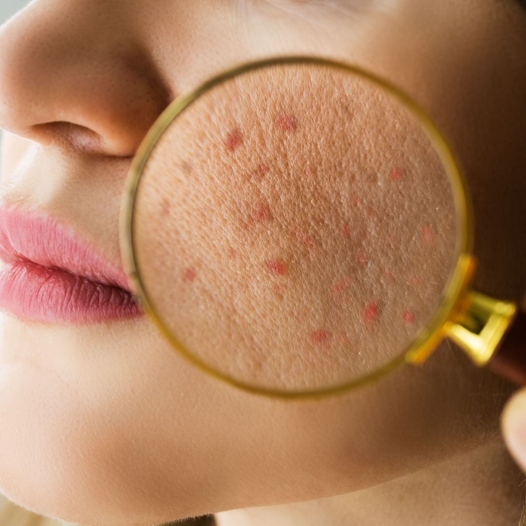 How to Repair a Damaged Skin Barrier: An Expert Routine for Stressed Skin