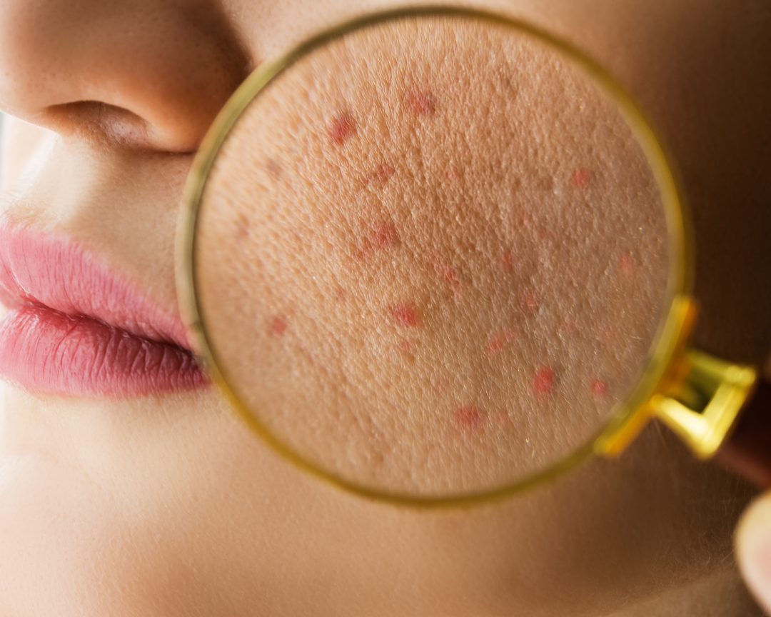 How to Repair a Damaged Skin Barrier: An Expert Routine for Stressed Skin