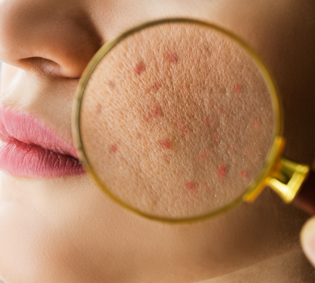 How to Repair a Damaged Skin Barrier: An Expert Routine for Stressed Skin